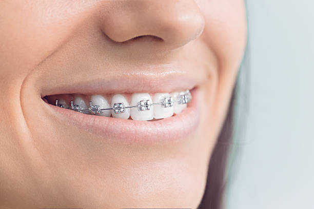 Best Traditional Braces  in Lake Summerset, IL